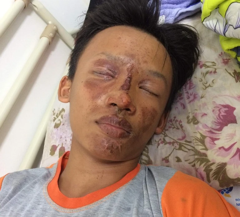 Giúp cháu Phương bị bỏng giác mạc